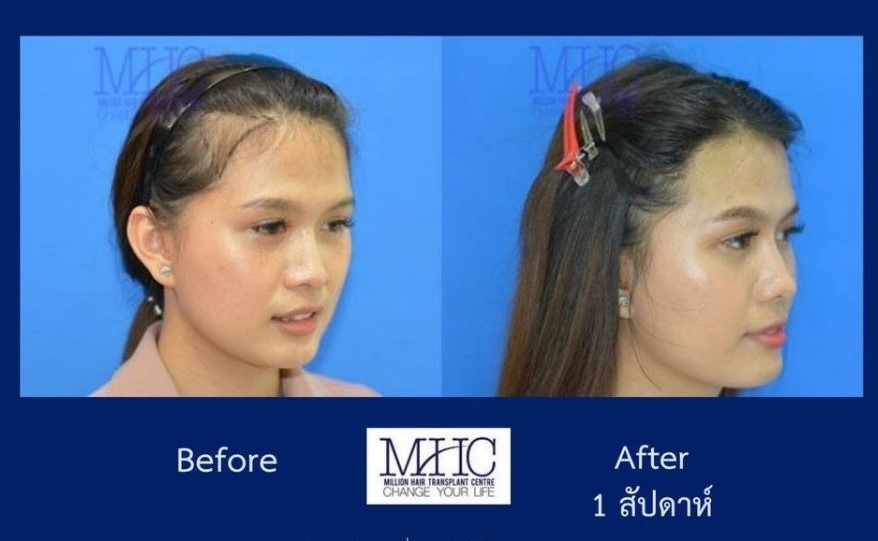 ศูนย์ปลูกผม MHC Million Hair Clinic